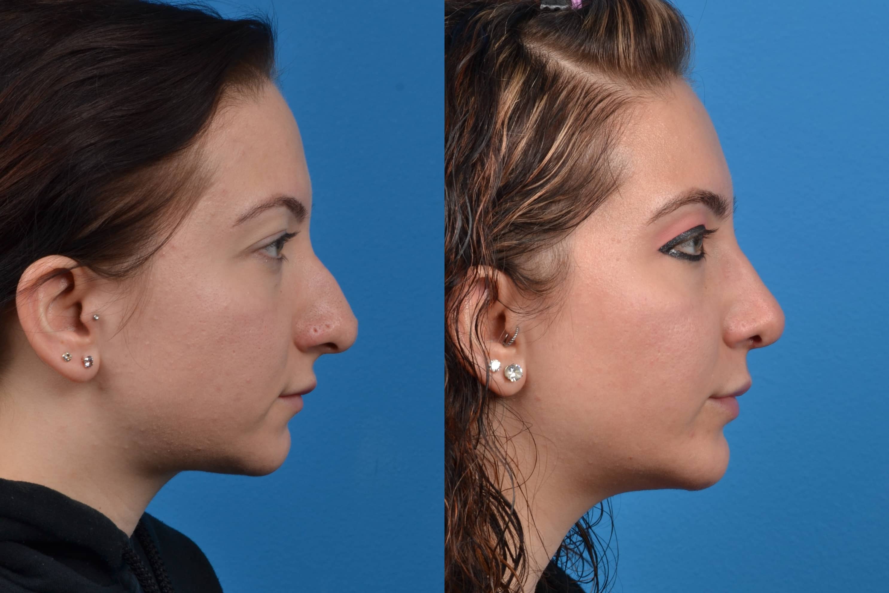 Chin Augmentation Photos | Melbourne, FL | Patient 14603